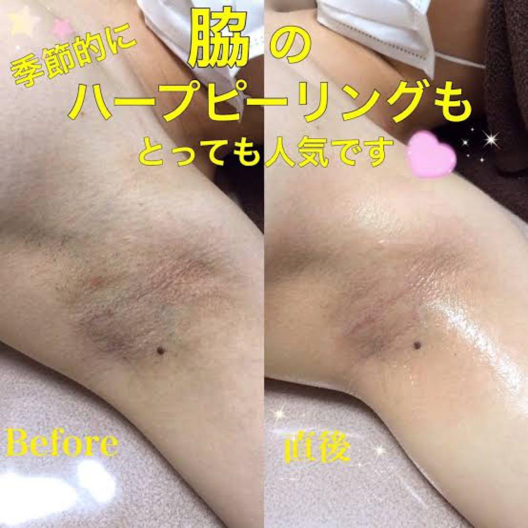 ボディ&フェイス　ハーブピーリング　剥離あり皮剥けあり➡︎７ｇ