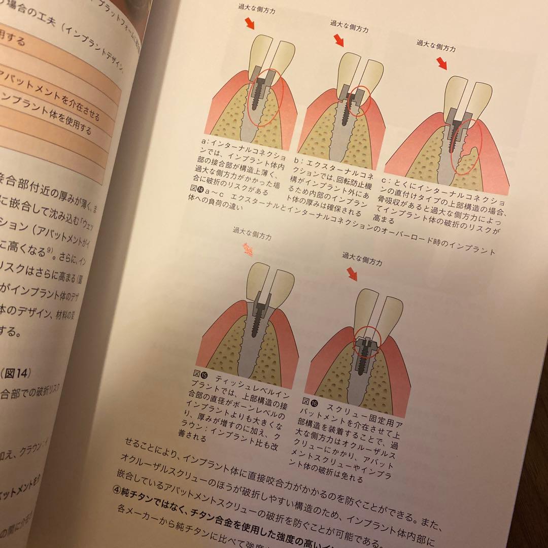 インプラントの撤去