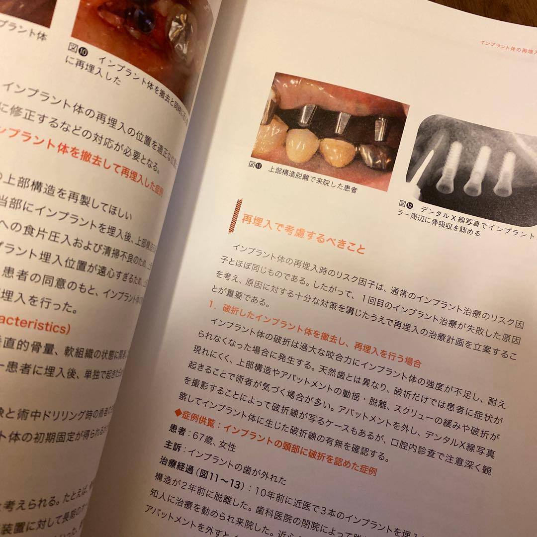 インプラントの撤去