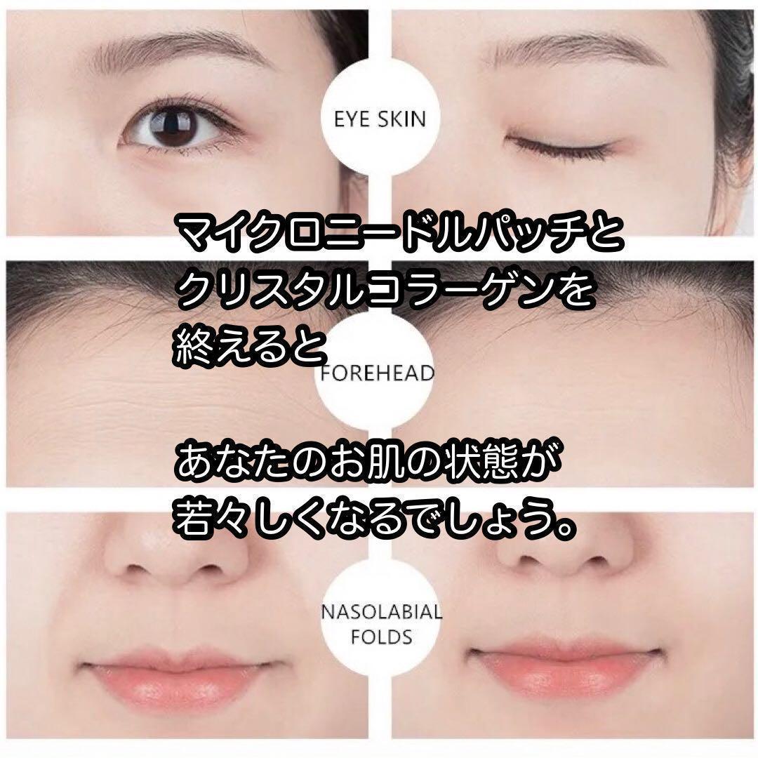 【2000針】100回分のマイクロニードルパッチ ヒアルロン酸 くま しわ