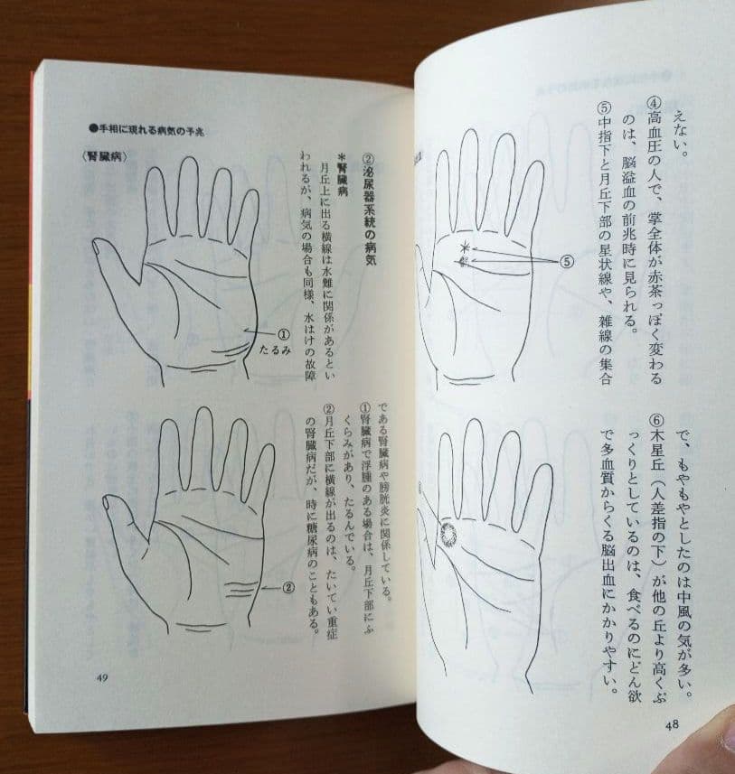 手相で病気を早期発見―患者の手形で実証した
