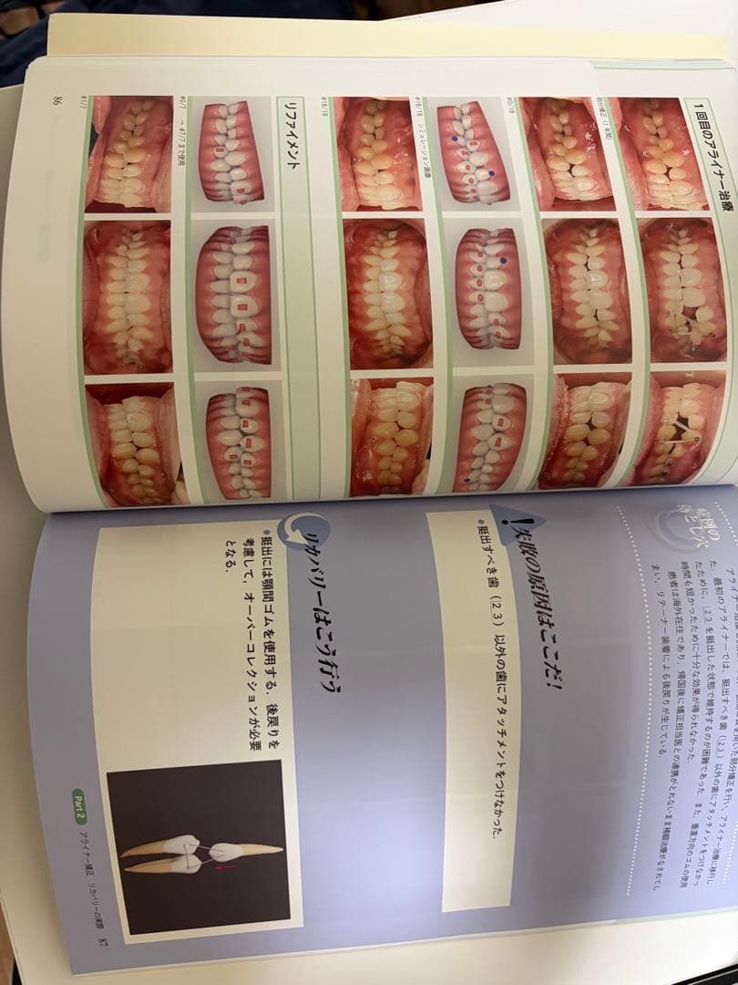 アライナー矯正のリカバリーテクニック