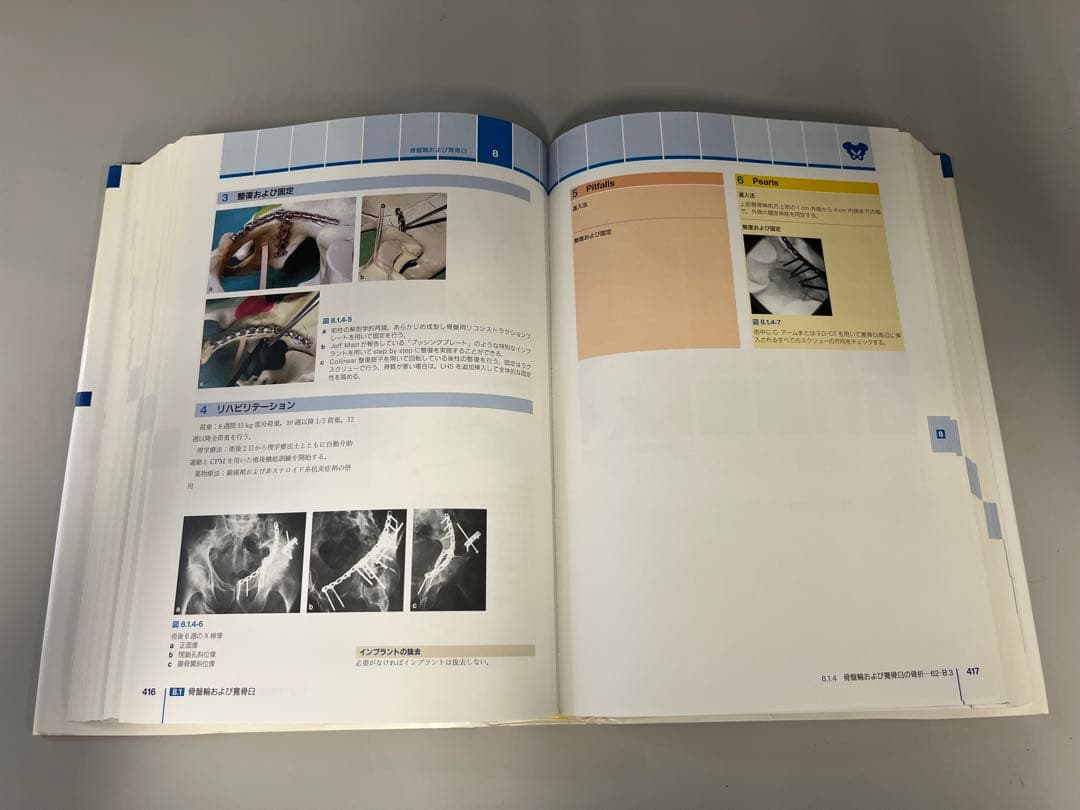 AO法 骨折治療 Internal Fixators