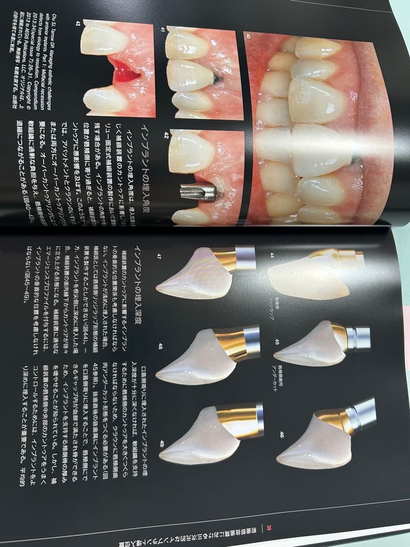 シングル・トゥース インプラント