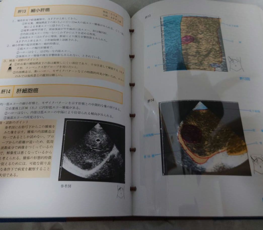 消化器超音波診断 : over lay方式 : 腹部エコーの描出手技と読影