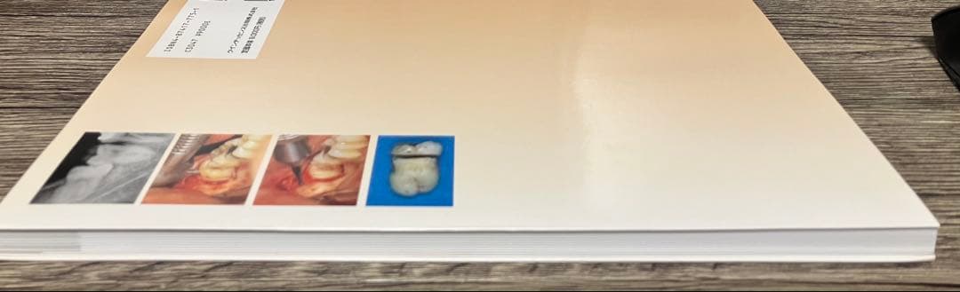 智歯の抜歯ナビゲーション