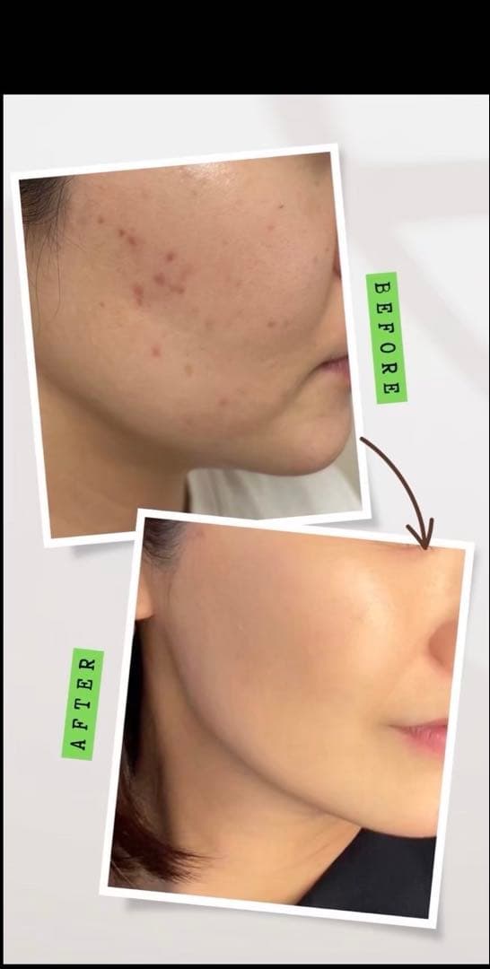 【セール】剥離ありハーブピーリング20回分