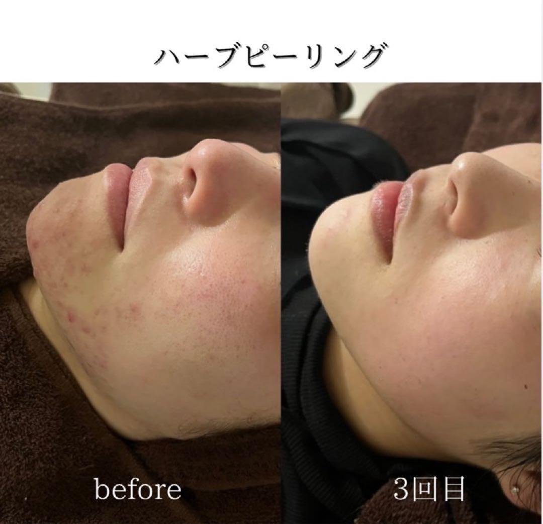 【大特価年末セール】剥離ありハーブピーリング20回分