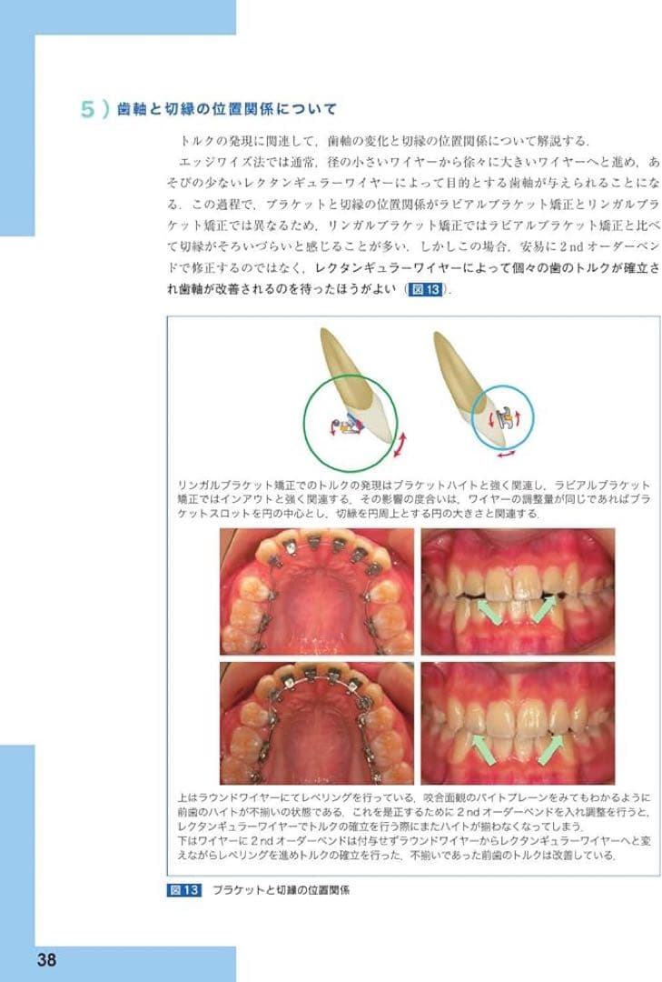 【裁断済み】リンガルブラケット矯正の臨床