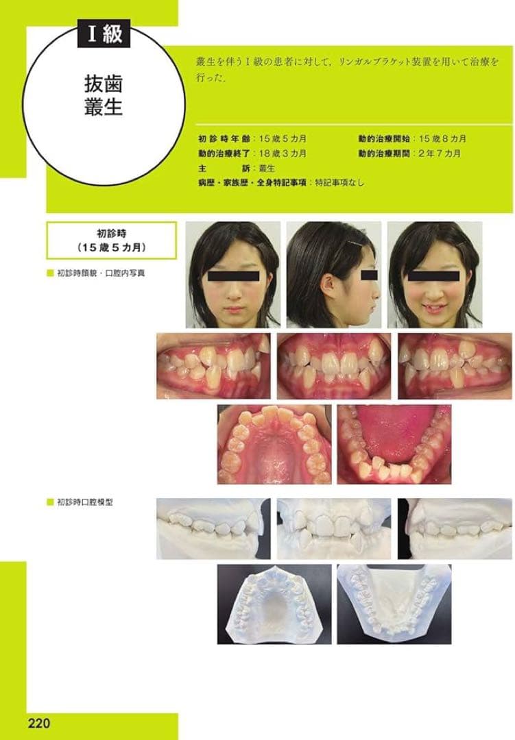 【裁断済み】リンガルブラケット矯正の臨床