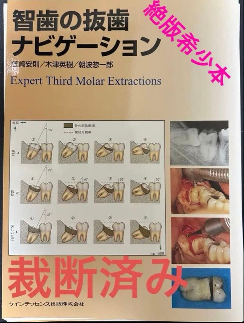 智歯の抜歯ナビゲーション