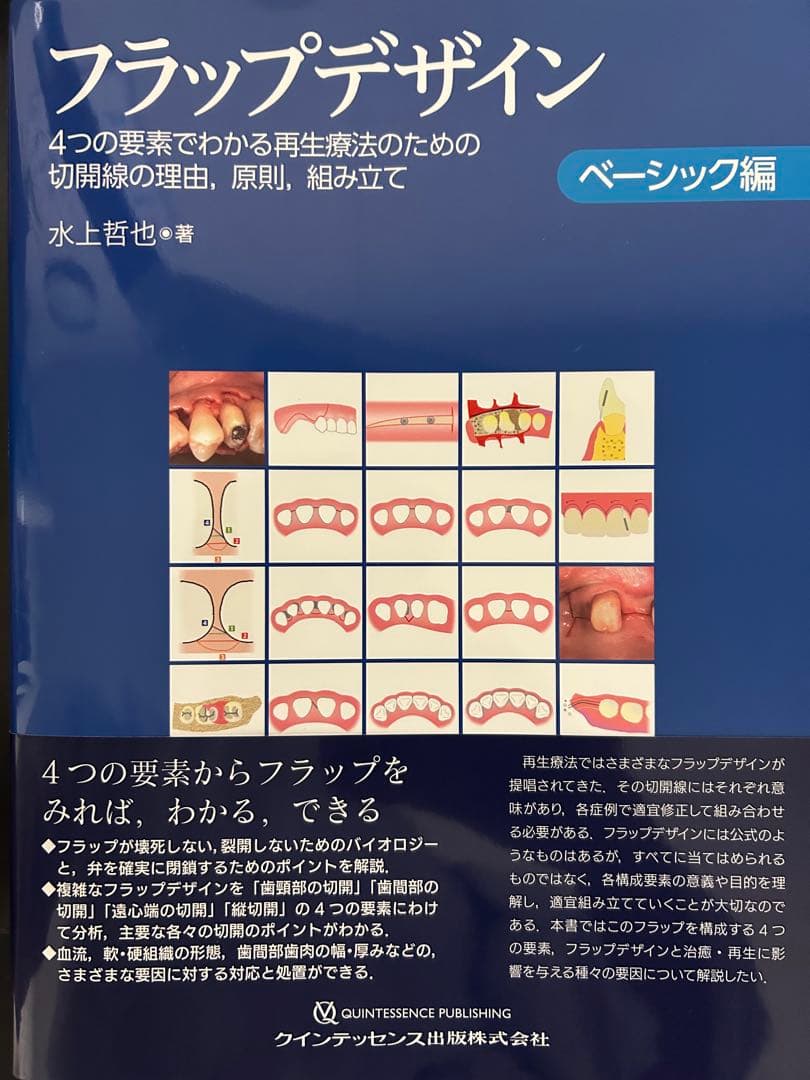 【裁断済】フラップデザイン : 4つの要素でわかる再生療法のための切開線の理由，