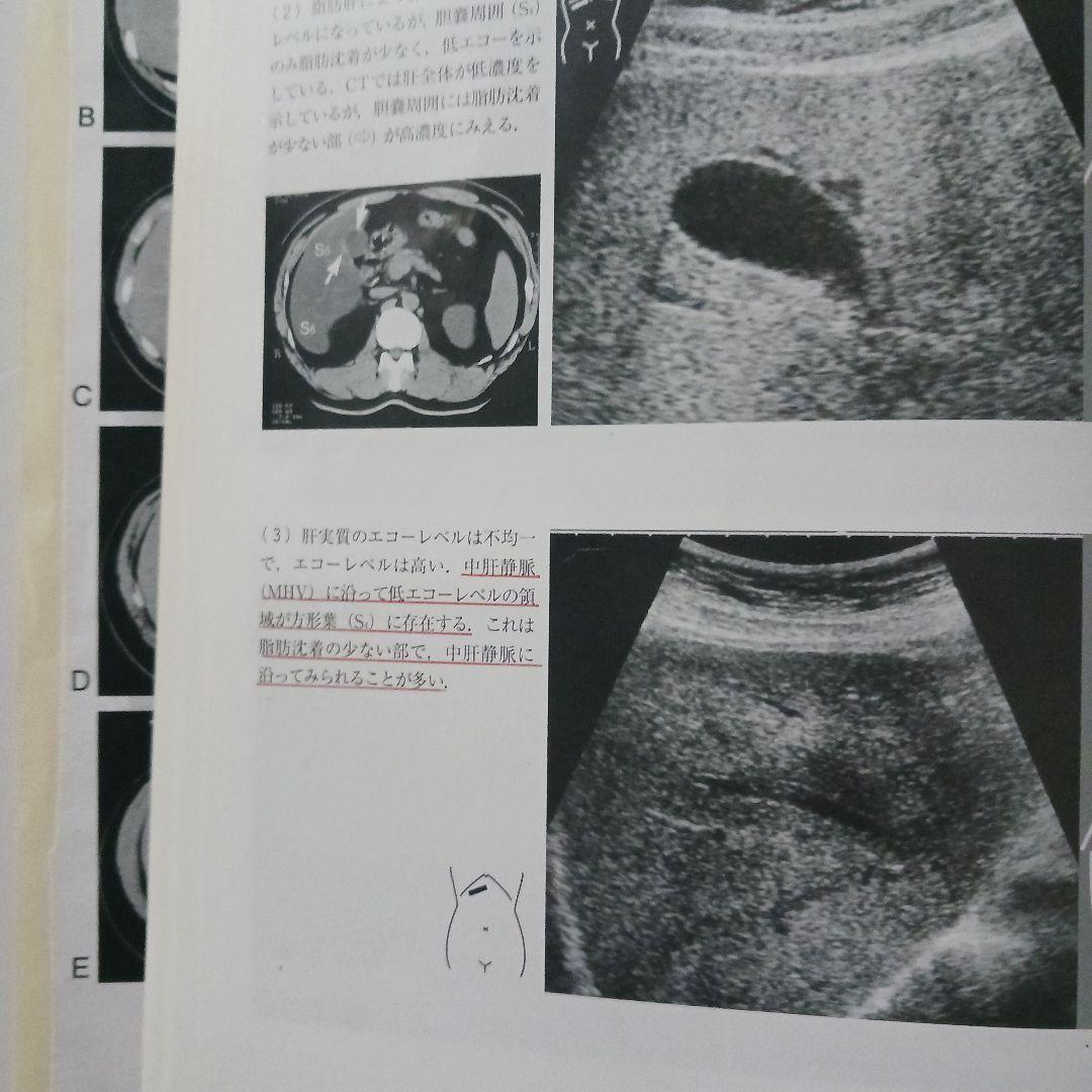 腹部超音波テキスト : 上・下腹部　腹部エコー　参考書　ベクトル・コア
