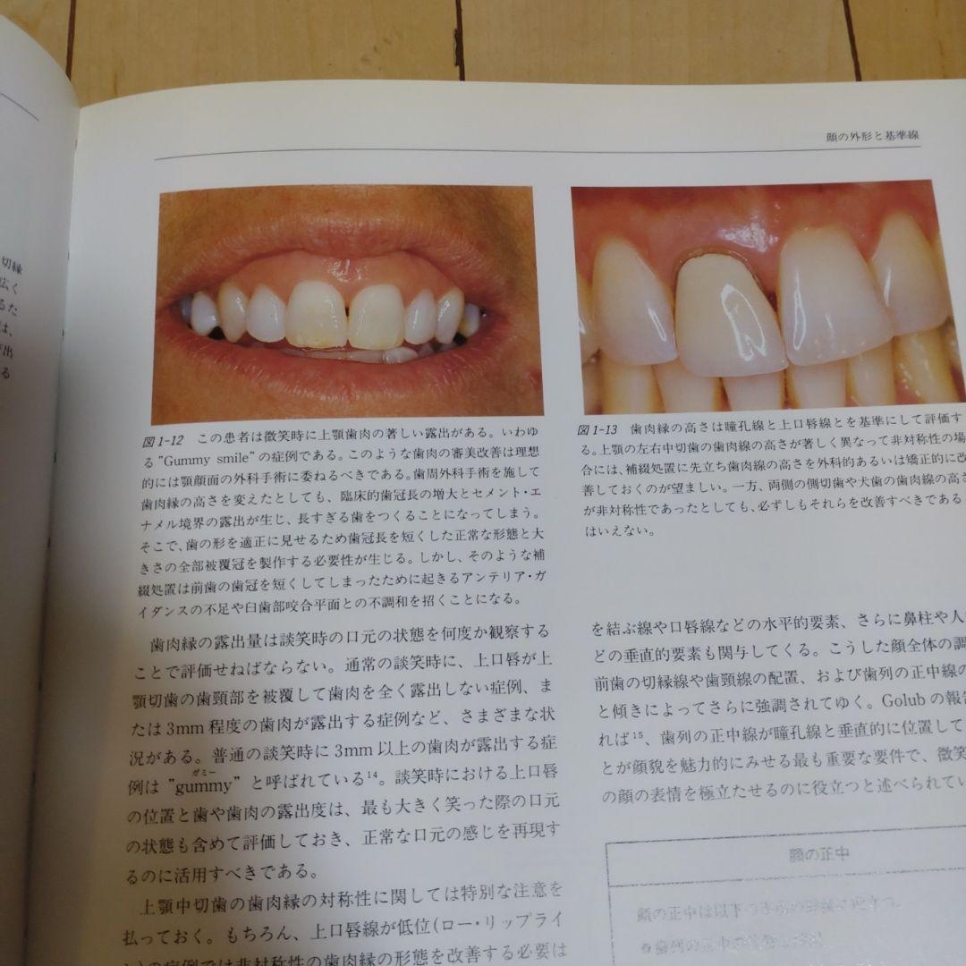 シーシェの審美補綴