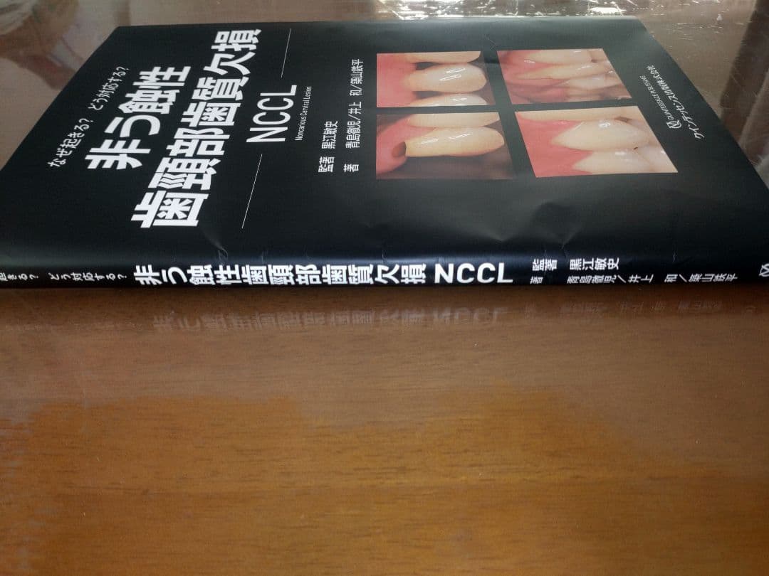 【裁断済み】非う蝕性歯頸部歯質欠損ＮＣＣＬ