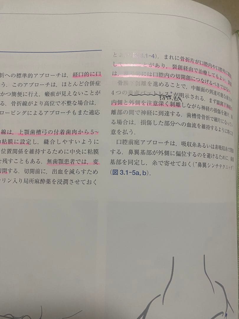 AO法 骨折治療 頭蓋顎顔面骨の内固定