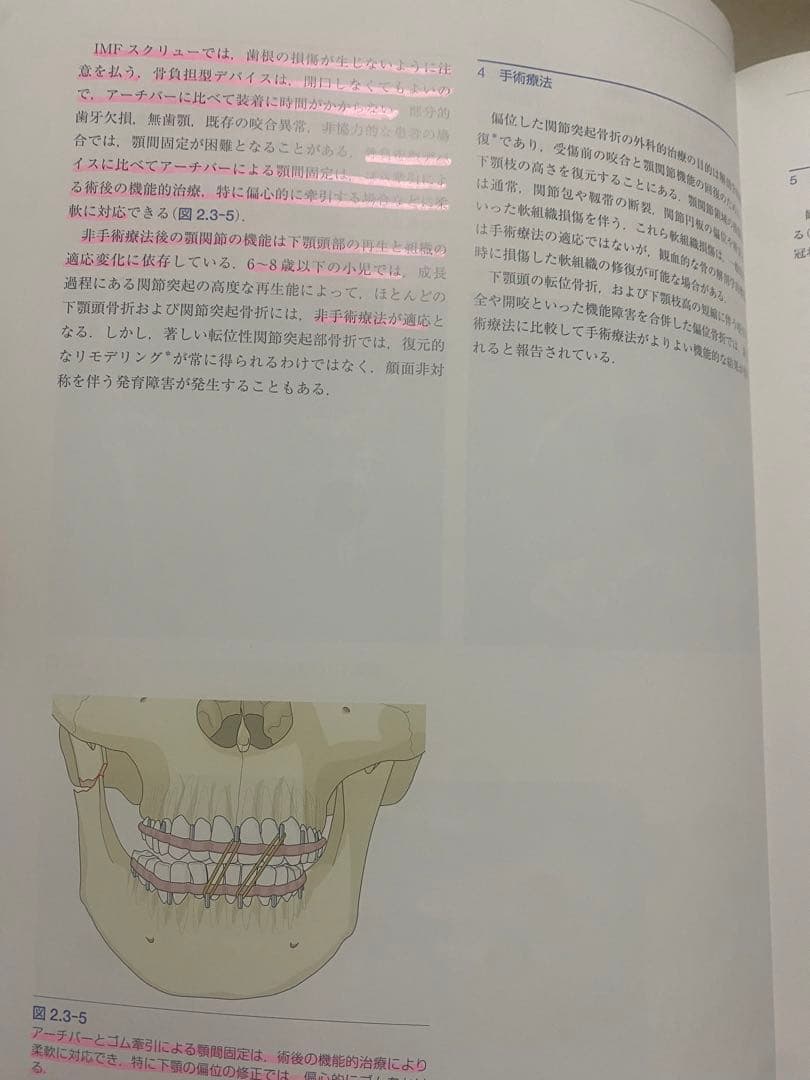 AO法 骨折治療 頭蓋顎顔面骨の内固定