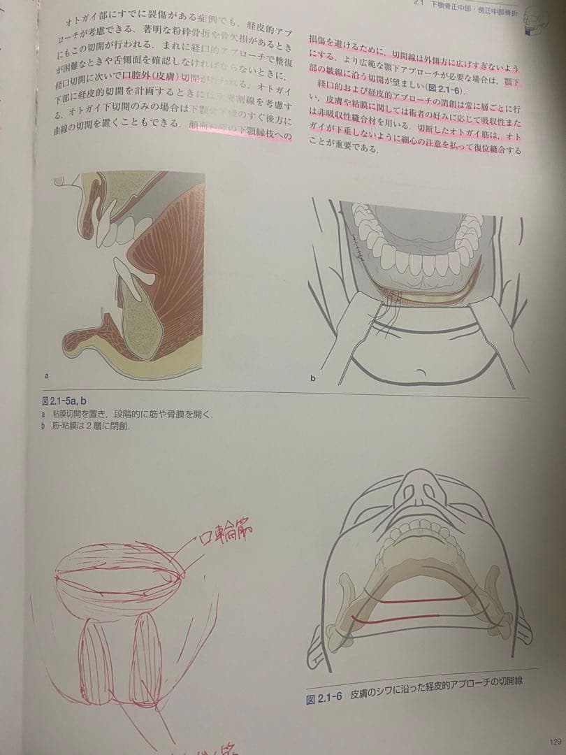 AO法 骨折治療 頭蓋顎顔面骨の内固定
