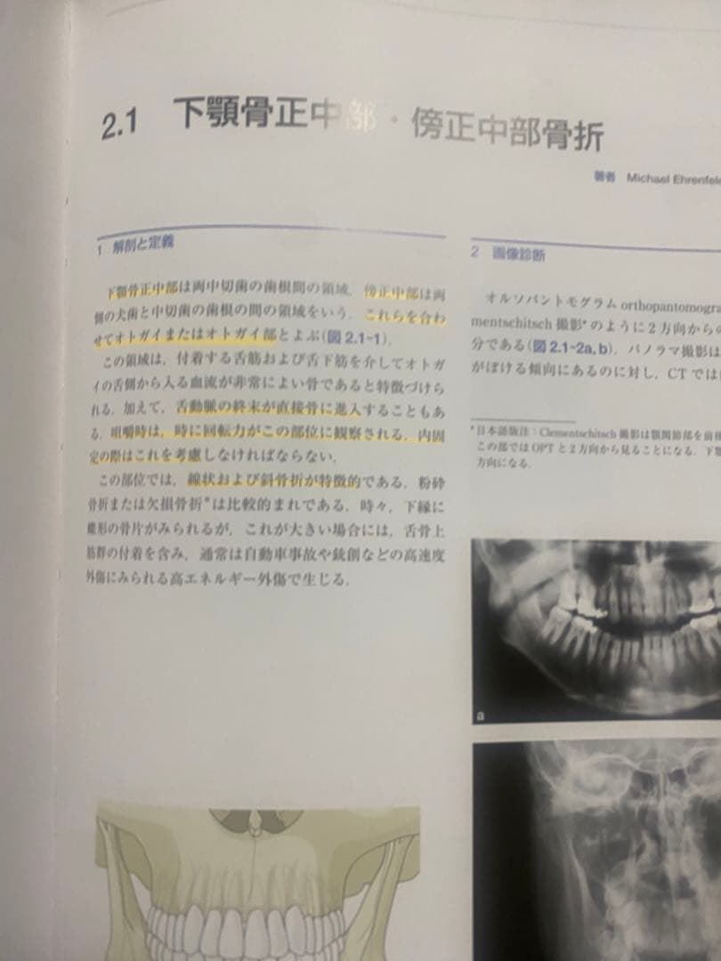 AO法 骨折治療 頭蓋顎顔面骨の内固定