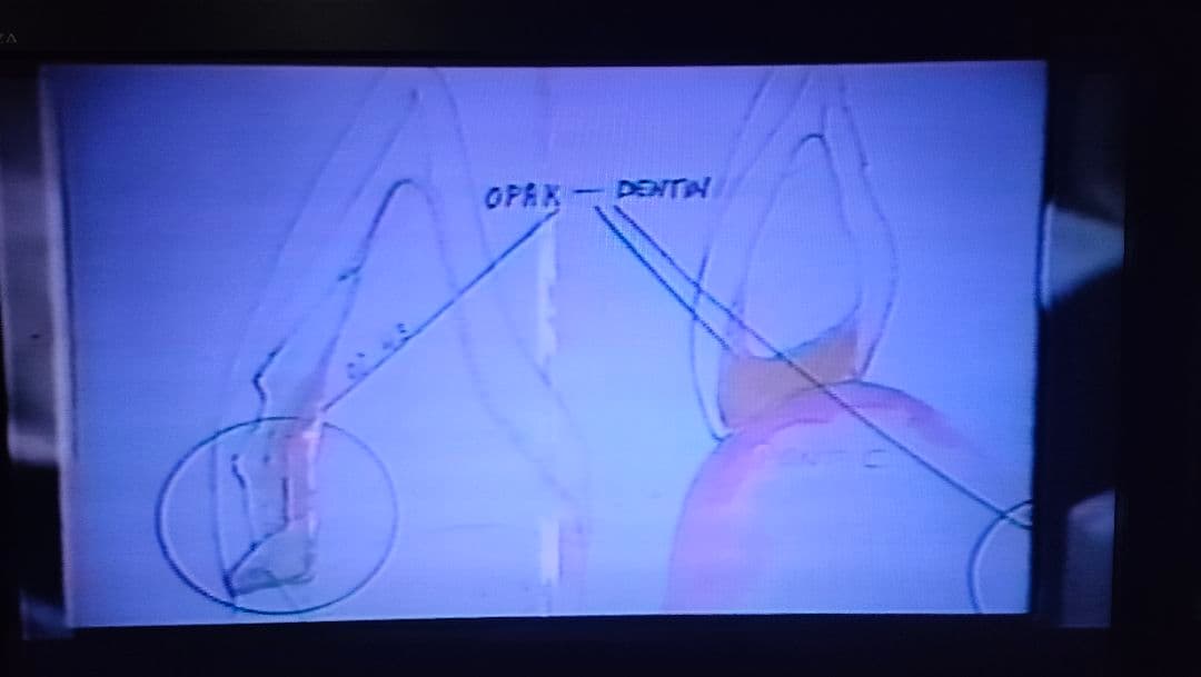 ウィリーゲラー氏の講演とテーブルクリニックビデオ　3本　ポーセレン　歯科技工