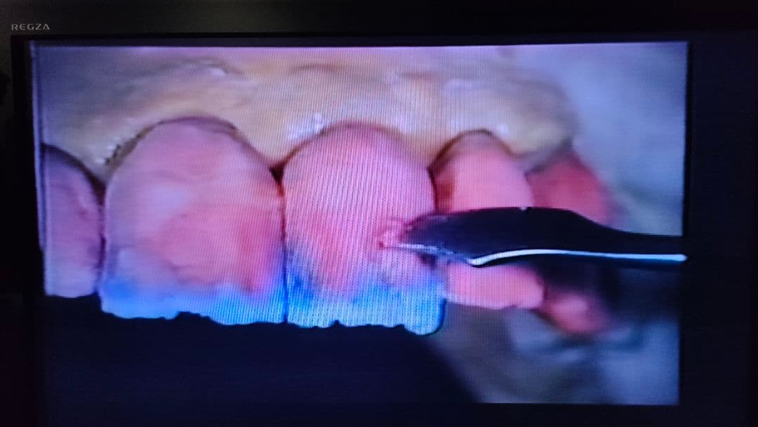 ウィリーゲラー氏の講演とテーブルクリニックビデオ　3本　ポーセレン　歯科技工