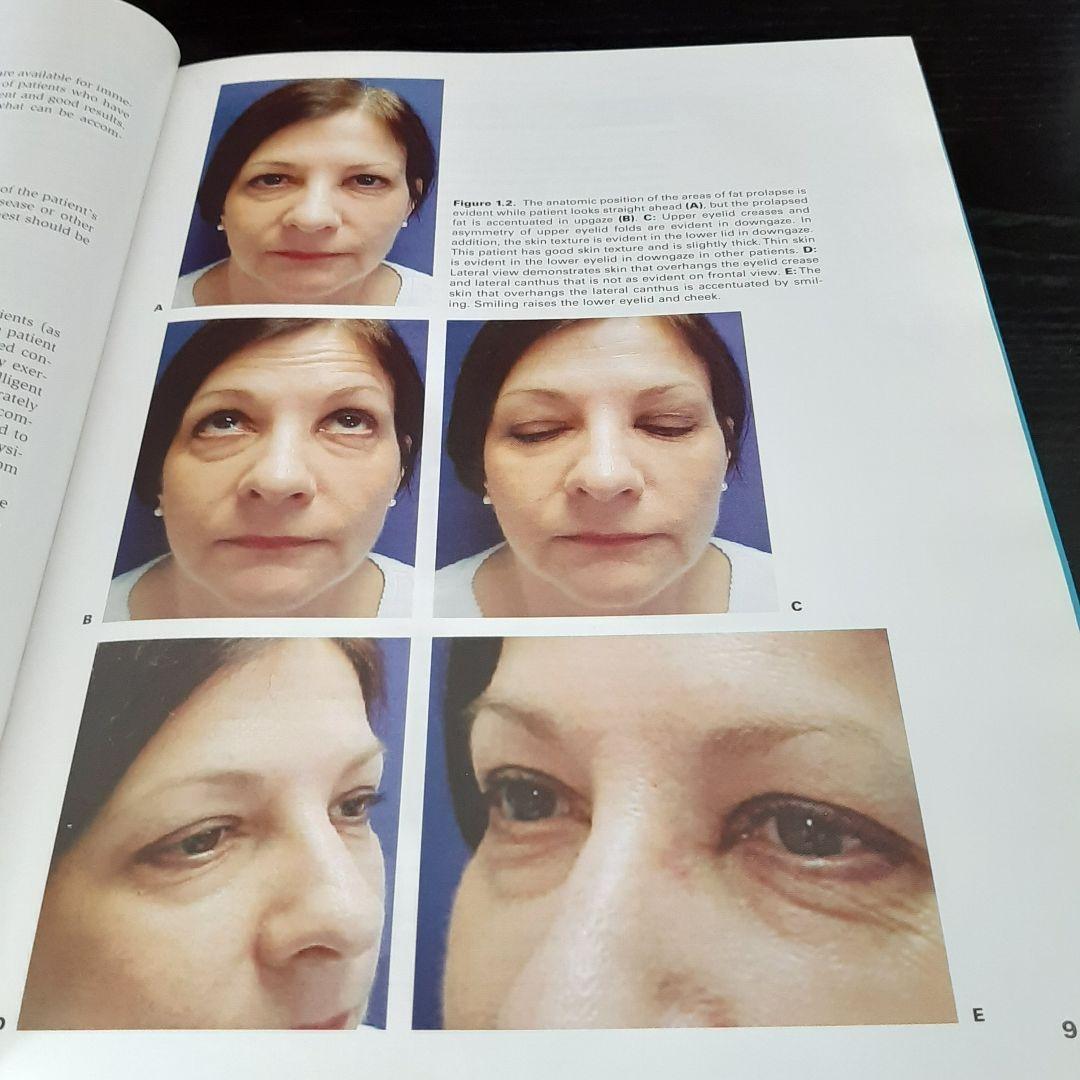 美容眼瞼下垂手術テキスト（英語版）