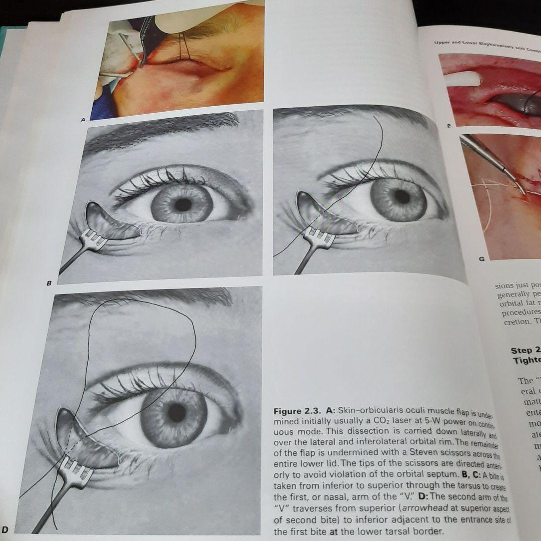 美容眼瞼下垂手術テキスト（英語版）