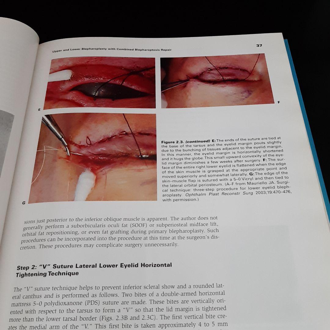 美容眼瞼下垂手術テキスト（英語版）