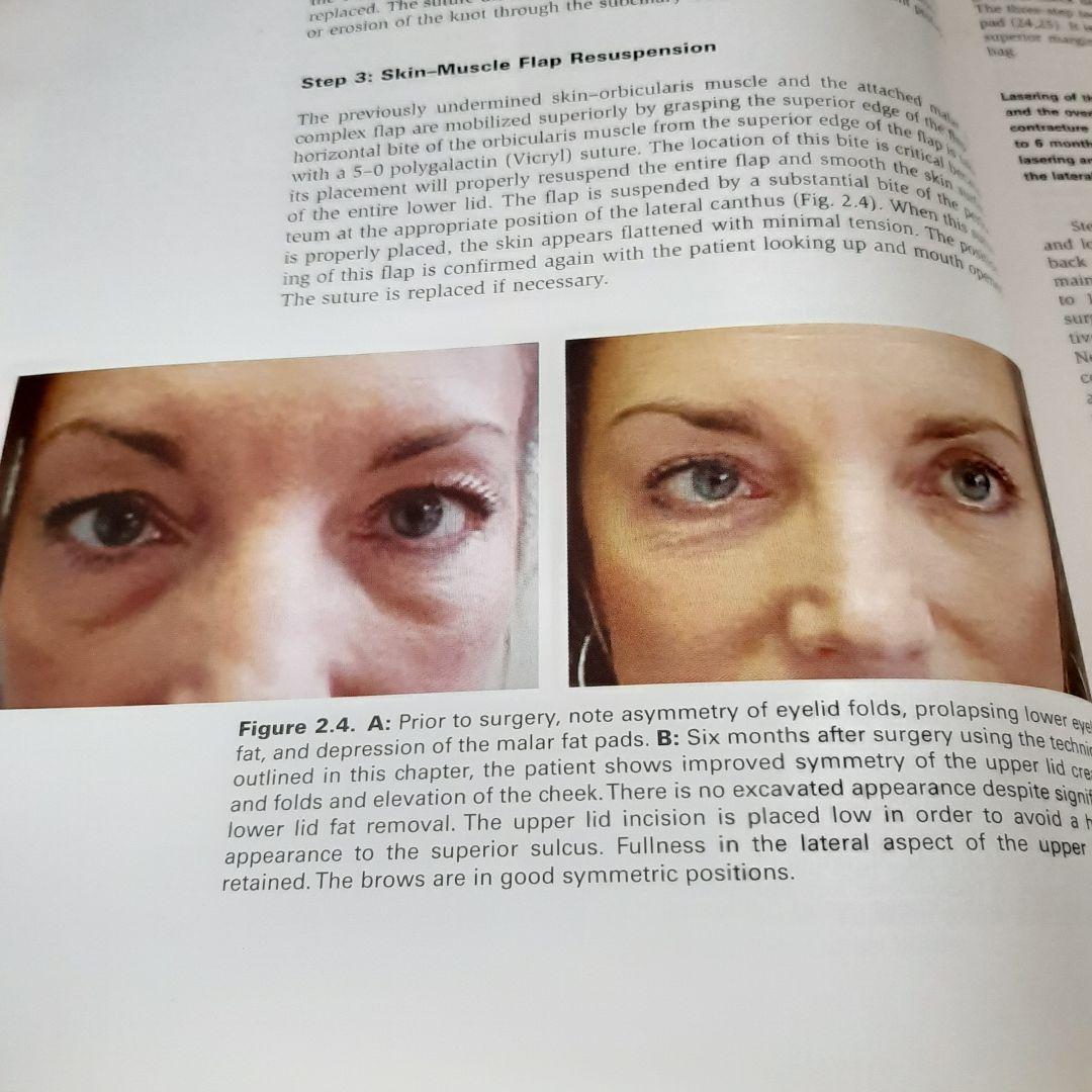 美容眼瞼下垂手術テキスト（英語版）