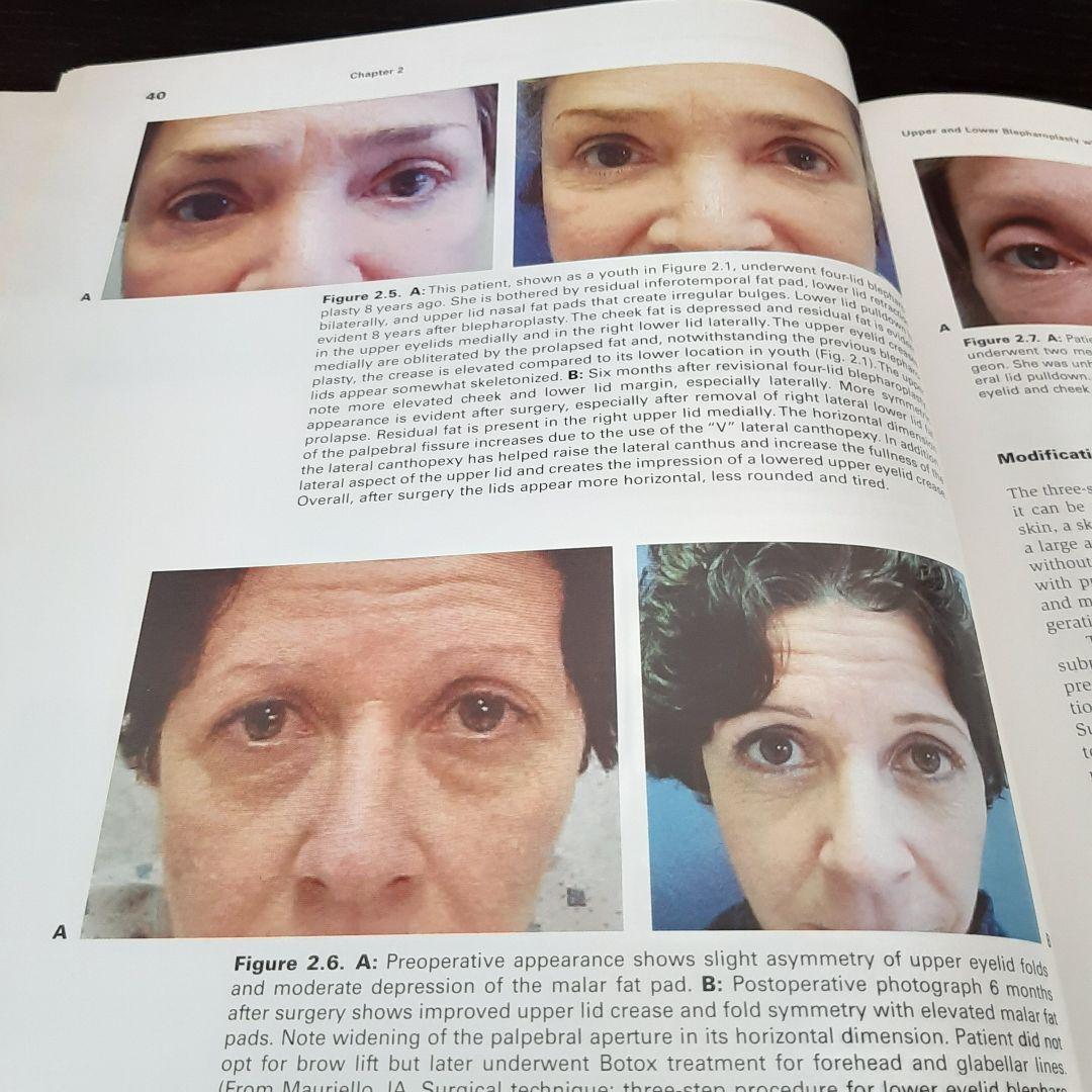 美容眼瞼下垂手術テキスト（英語版）