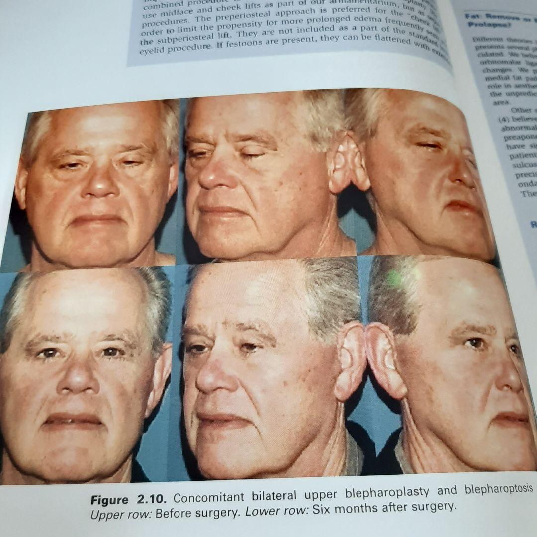 美容眼瞼下垂手術テキスト（英語版）