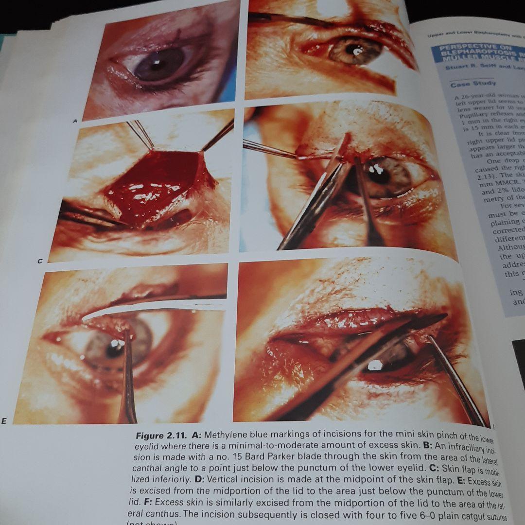 美容眼瞼下垂手術テキスト（英語版）