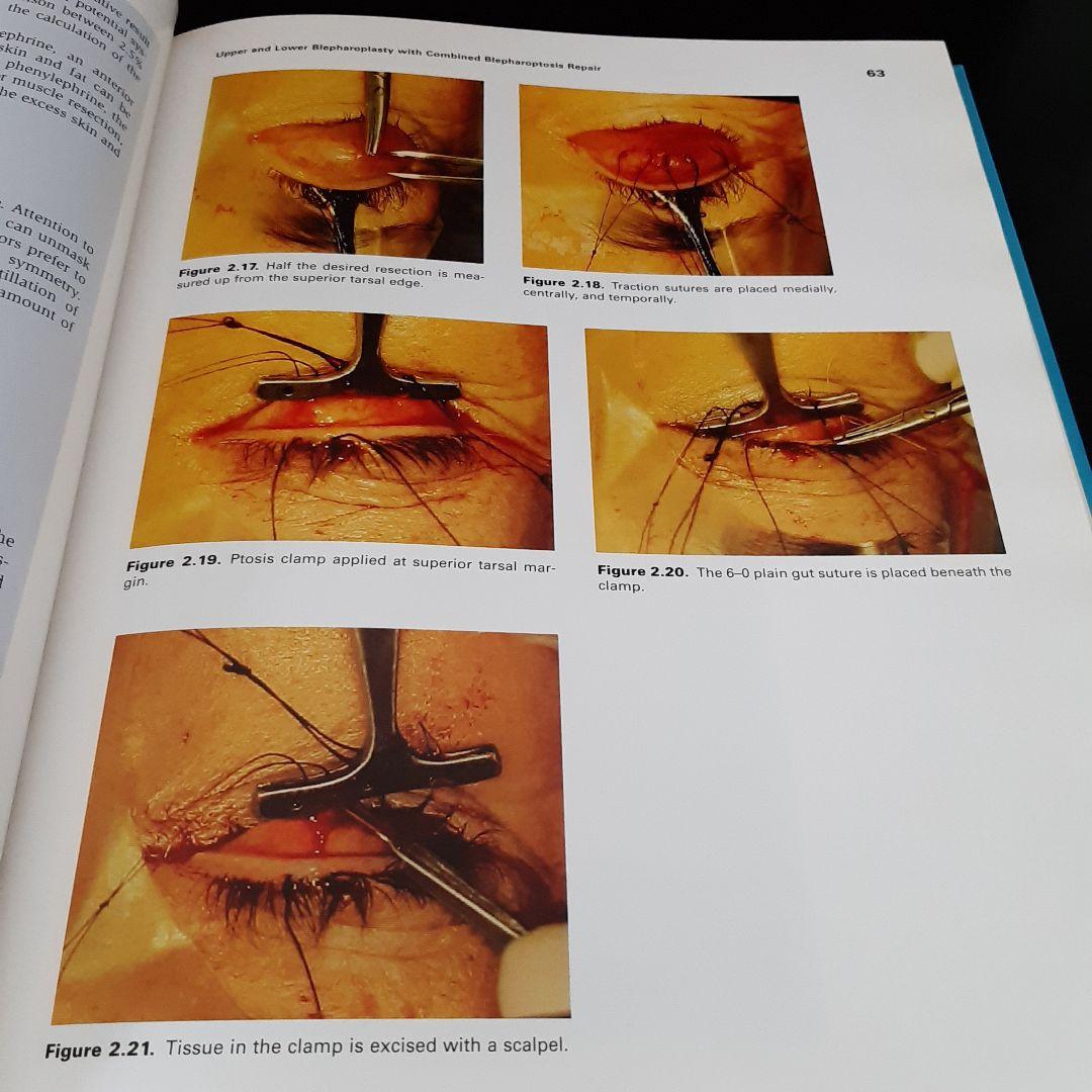 美容眼瞼下垂手術テキスト（英語版）