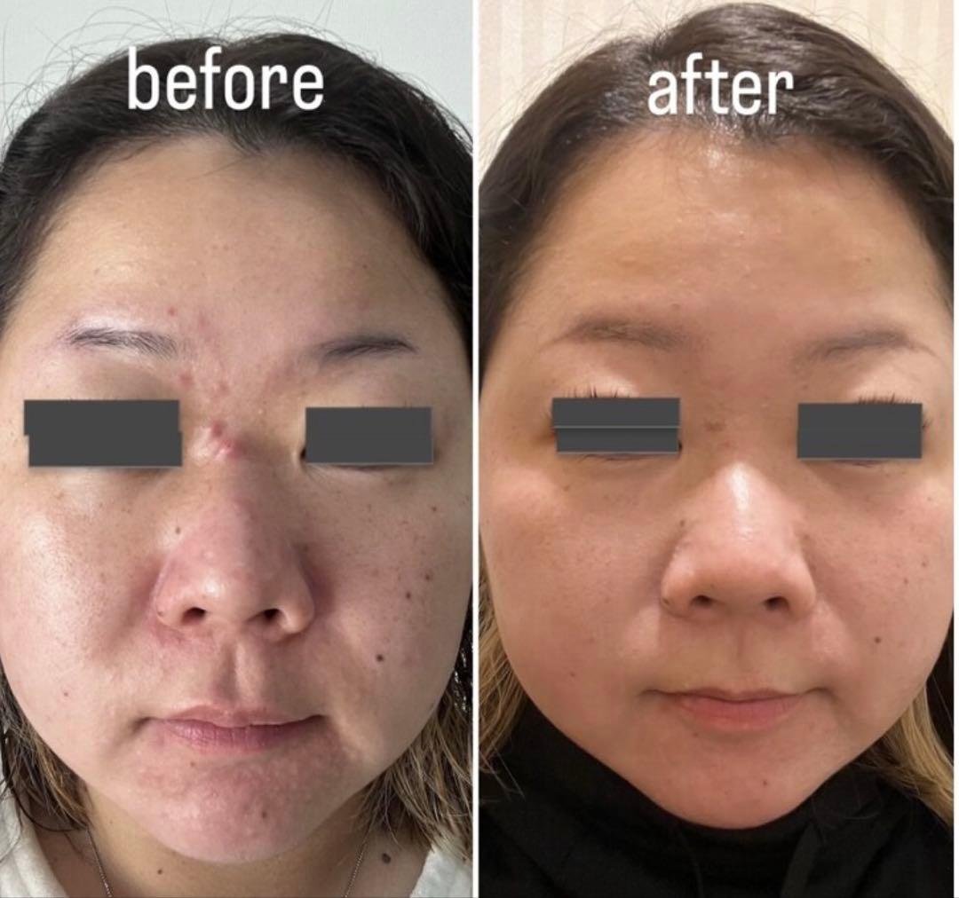 ハーブピーリング 剥離あり　皮向けあり　10回分→10g