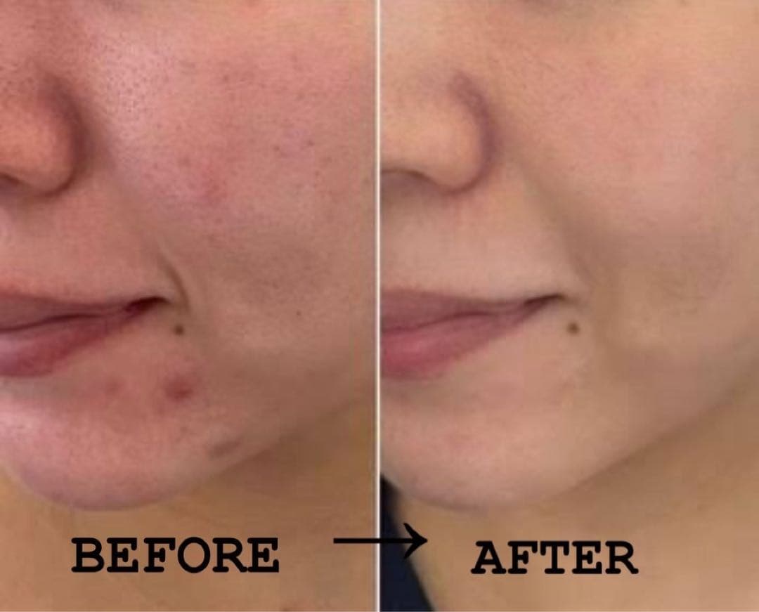 ハーブピーリング 剥離あり　皮向けあり　10回分→10g