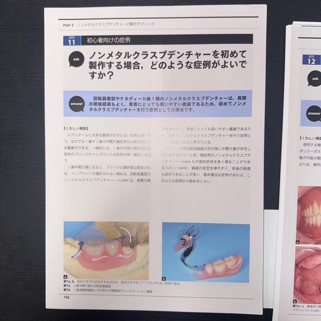 ノンメタルクラスプデンチャー