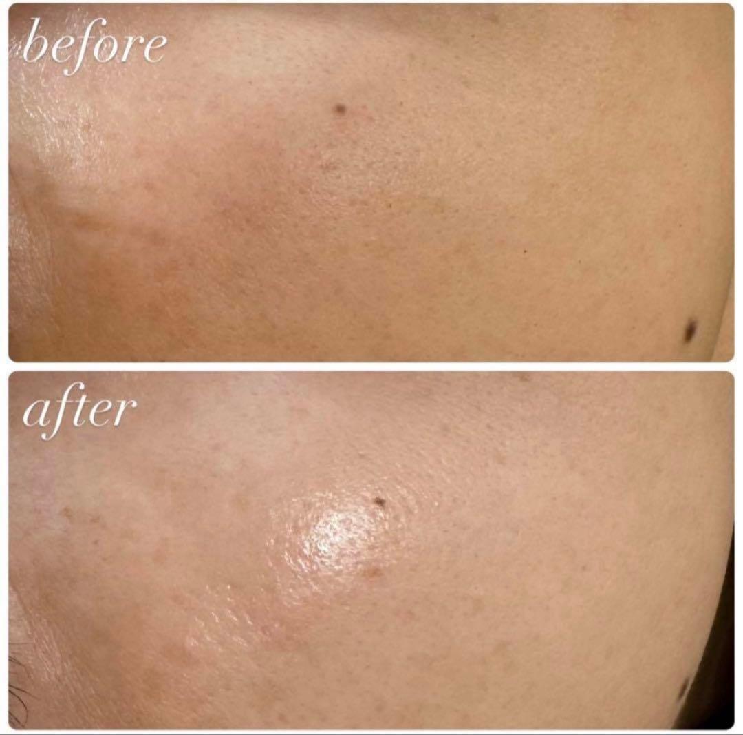 サロン専売品☆ハーブピーリング ダウンタイムなし！剥離なし！肌質改善 小分け販売