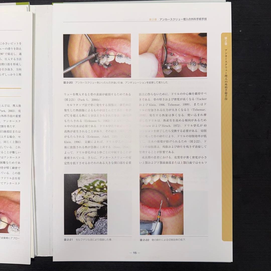 アンカースクリューを用いた新しいMTM矯正 ここまで変わる補綴前矯正