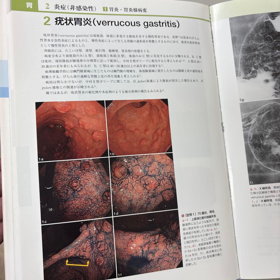 胃と腸アトラスⅠ 上部消化管、II 下部消化管 第2版