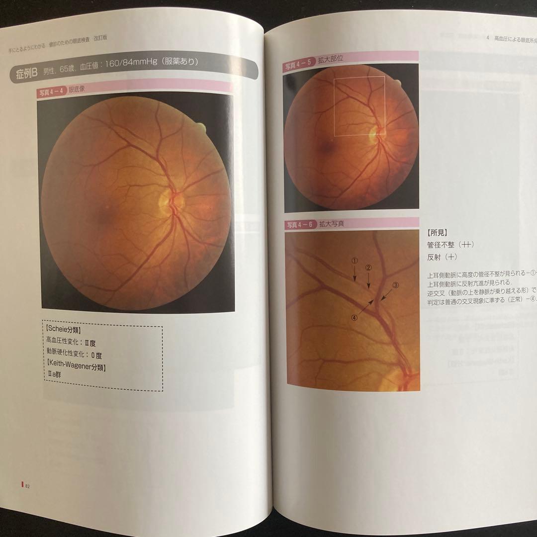 手にとるようにわかる健診のための眼底検査 改訂版