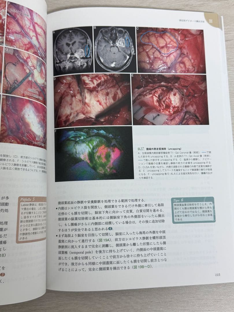 プライム脳神経外科 外科治療の最前線!エキスパートのテクニカルノート 4