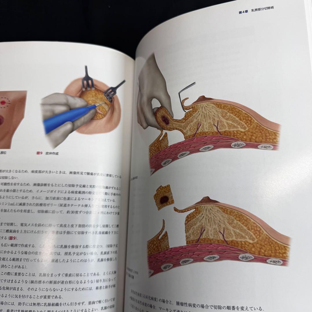 国立がん研究センターの乳癌手術　美容外科基本手術　適応と術式