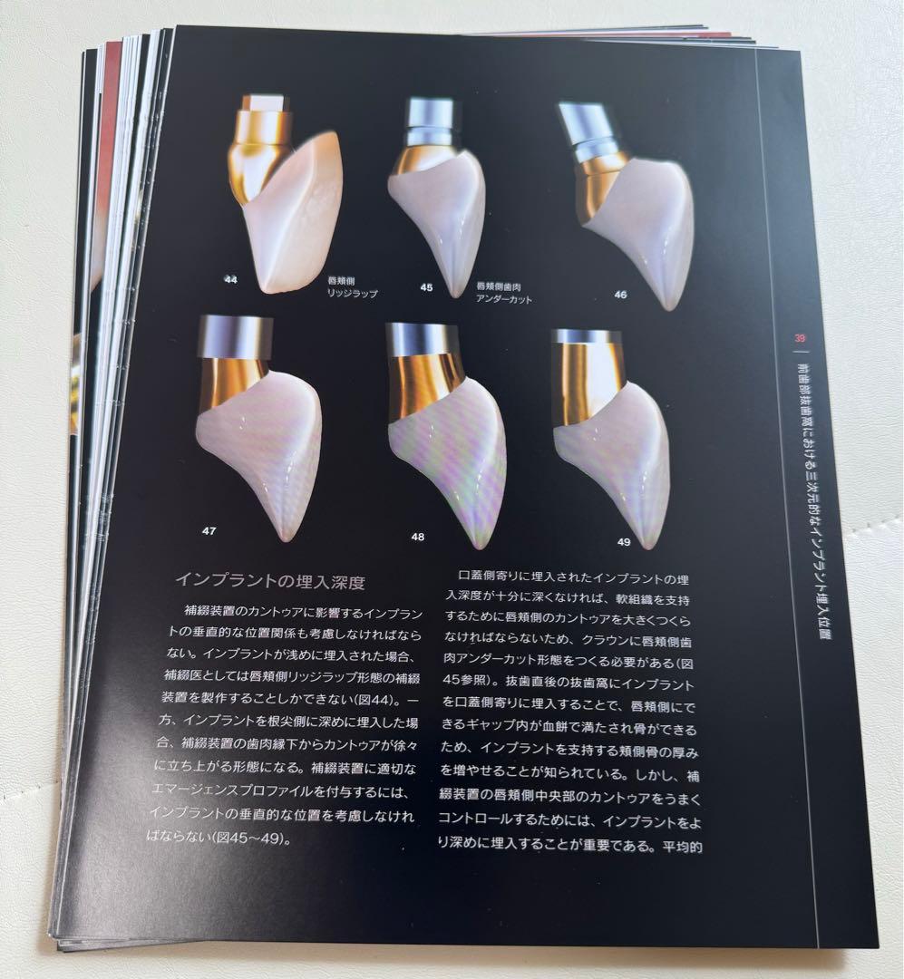 【裁断済】シングル・トゥース インプラント　前歯部および臼歯部抜歯窩に対する低侵