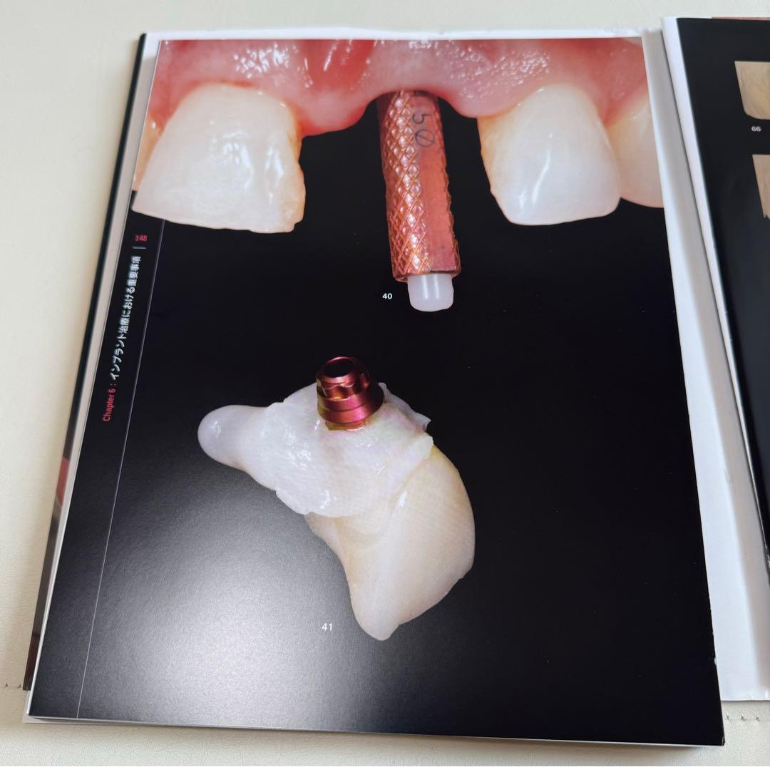 【裁断済】シングル・トゥース インプラント　前歯部および臼歯部抜歯窩に対する低侵