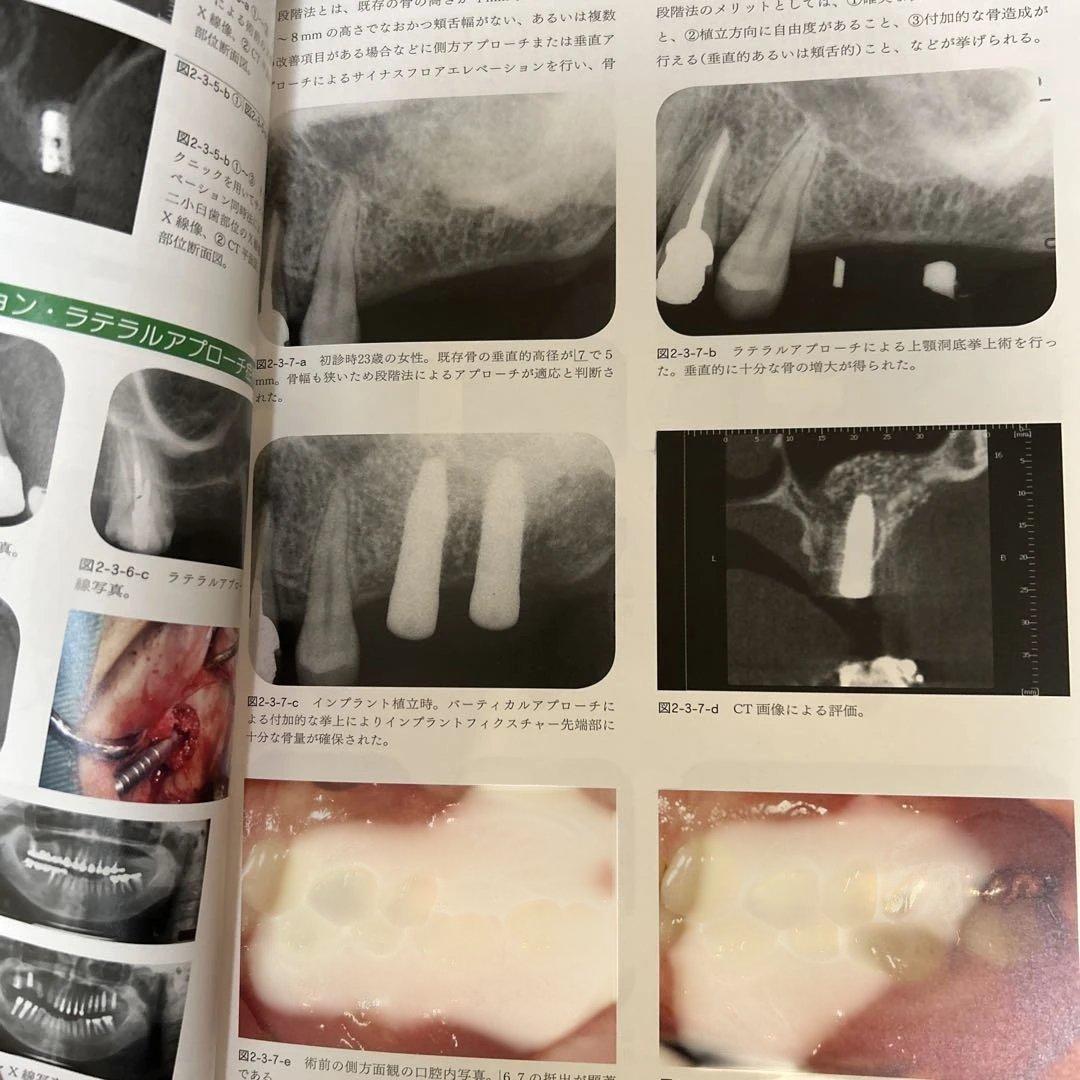 【希少】POI-EX SYSTEMの臨床 2006年版