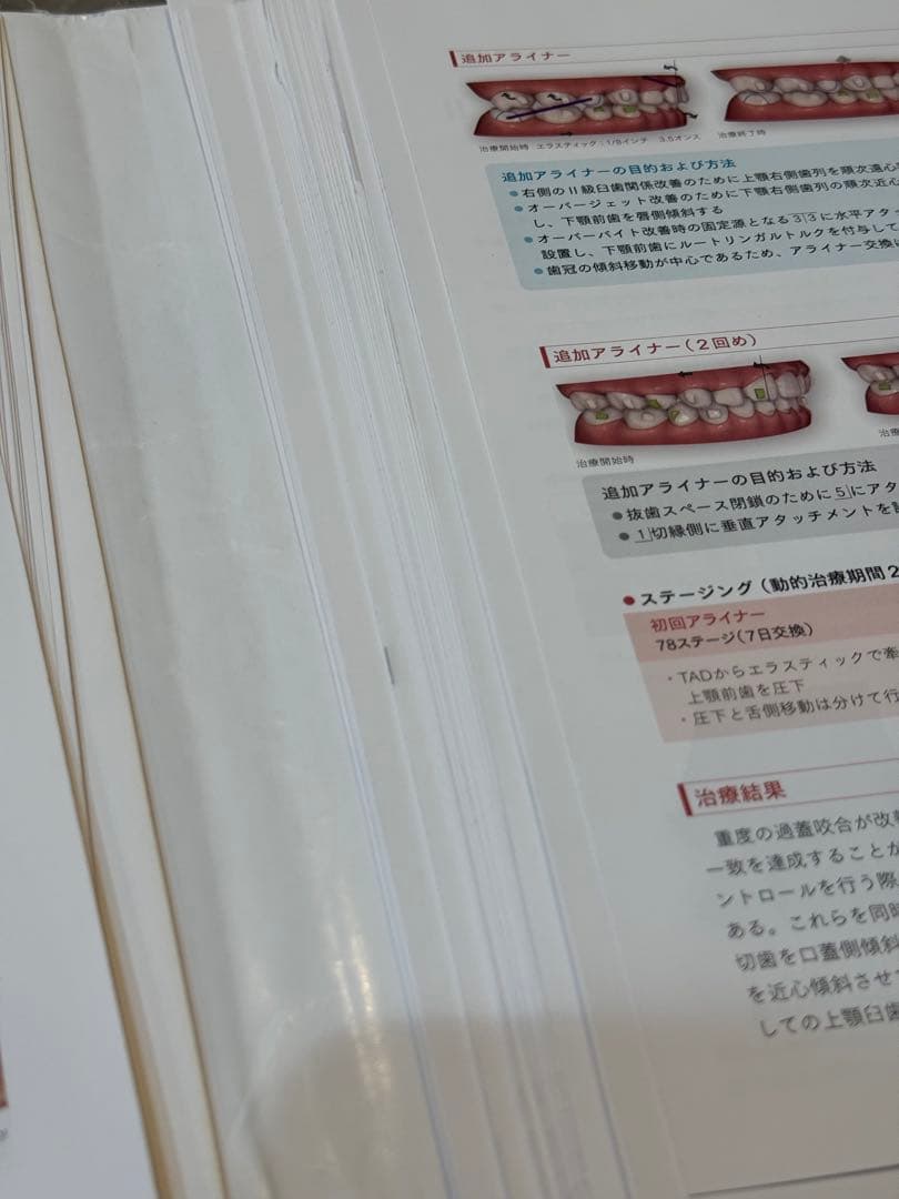 裁断済み　アライナー矯正 治療戦略