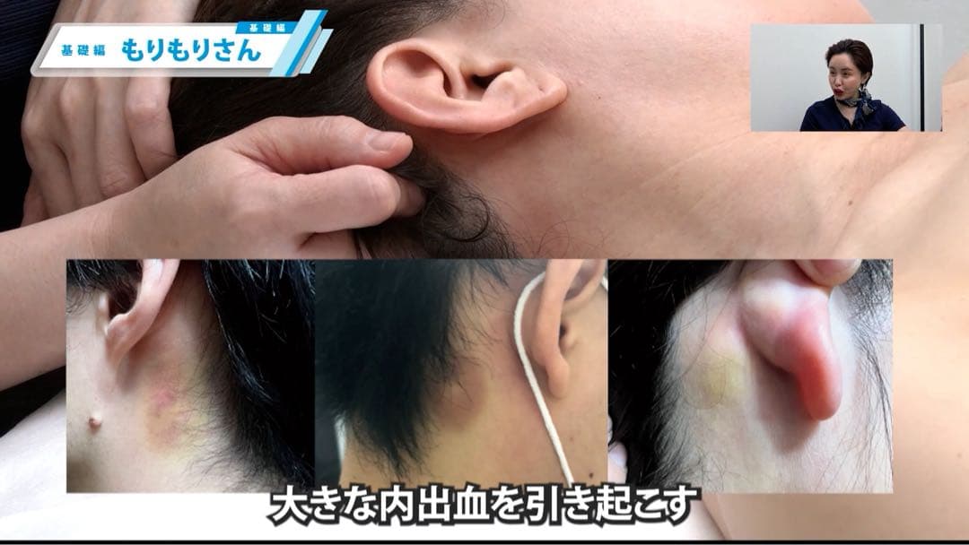 美容外科医複数人監修による美容鍼DVD