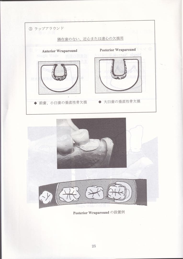 ゴアテックス　メンブレン　レジメ #歯科　　#インプラント