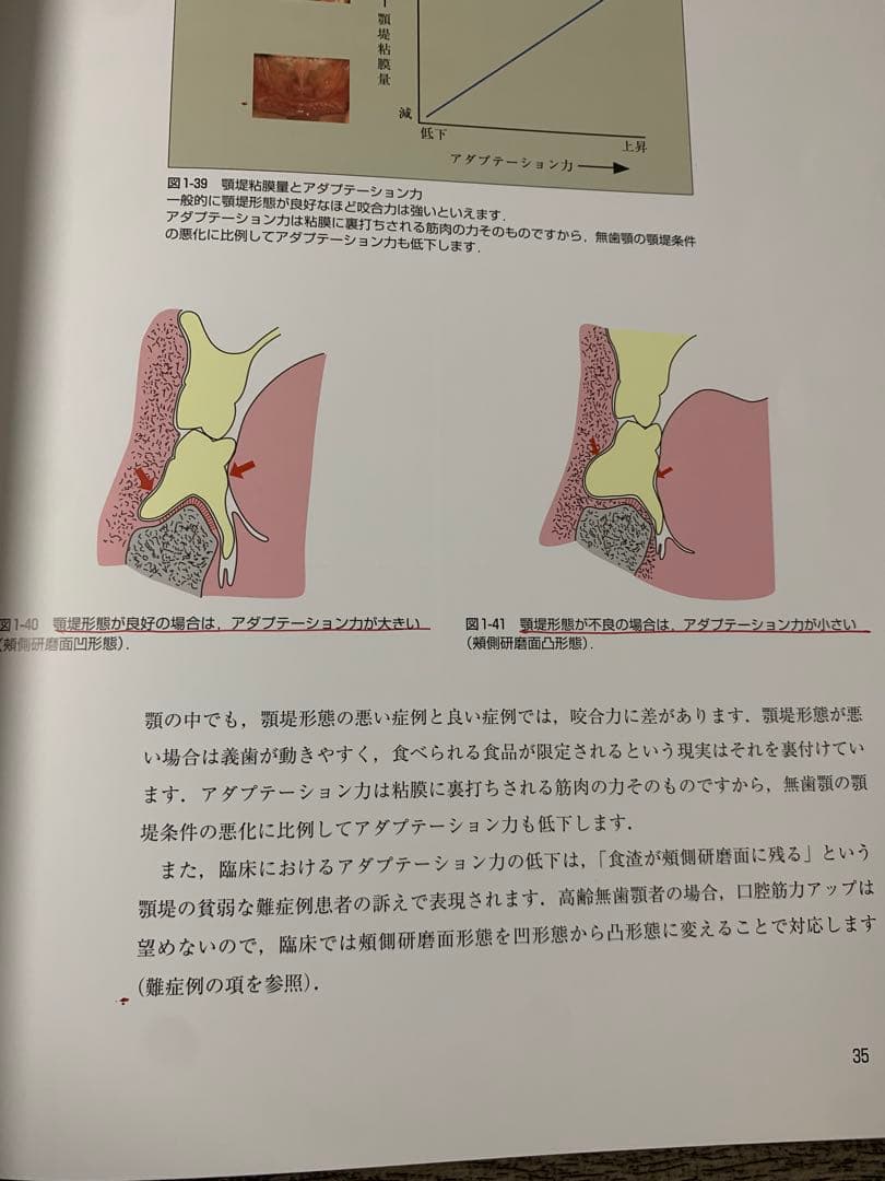 最終値下げ 誰にでもできる下顎総義歯の吸着 : カラーアトラス