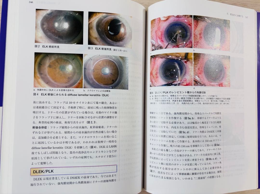 【一部書き込み有】眼科診療クオリファイ 角膜内皮障害 to the Rescue